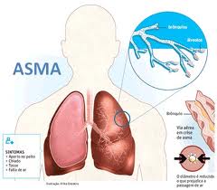 pengobatan-asma